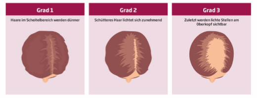 MINOXICUTAN Frauen 20 mg/ml Spray, 3X60 ml