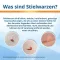 EndWarts® Extra gegen Stielwarzen, 14.3 g
